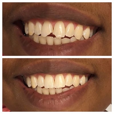 Chipped front teeth- Restored with Bonded fillings