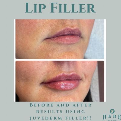 Before and After Juvederm lips filler!! #naturallooklipsfillers