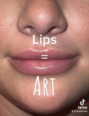 Building the perfect lips with filler and threads