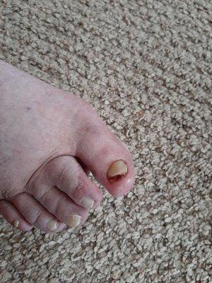 Sorry for the graphic image, but the podiatrist " Dr. Raatz" mangled my mothers toe nail.