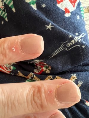 Chipped nail on my left hand and look at the skin around my nails.