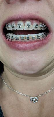 Don't judge the stains by my brackets, I hate these things!