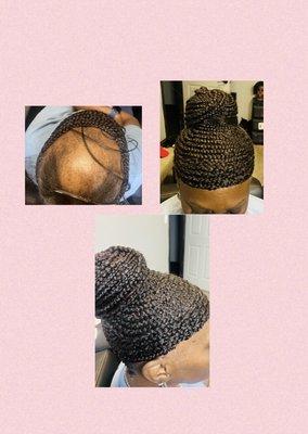 Alopecia  cornrows coverage