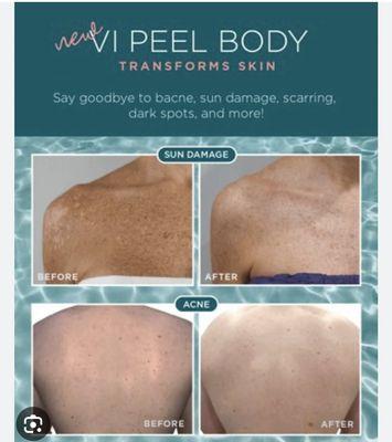 New Service! Vi Body Peels now available