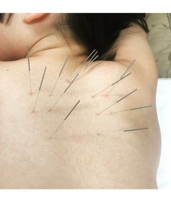 Children, pediatric acupuncture