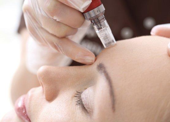 BB Glow or microneedling is a procedure that uses tiny needles to treat scars, enlarged pores, wrinkles, and stretch marks