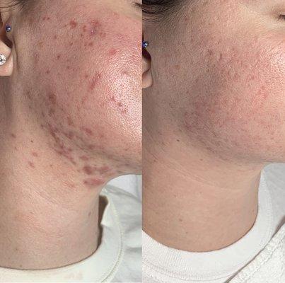 Chemical Peel Transformation (Left Photo- before, Right Photo- after)