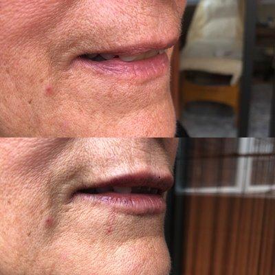 Before And after of lip definition and plumping with filler