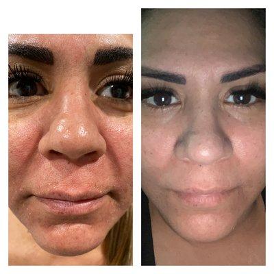 Non surgical face lift, it helps the skin with pigmentación and skin tightening