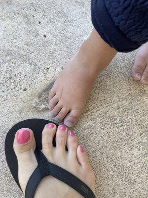 My daughters feet turning purple from onset of hypothermia