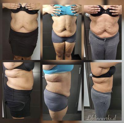 Service performed: Laser lipo, Cavitation, Skin Tightening, and Vacuum Therapy for 30 days.