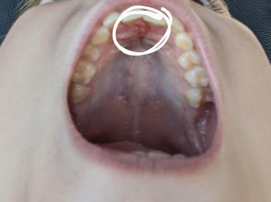 Damage to the roof of my sons mouth due to appliance breaking/being left in broken/removal.