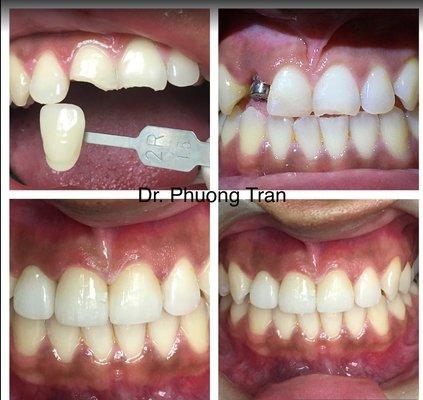 Before & after. 1 implant & 2 crowns on the front teeth.