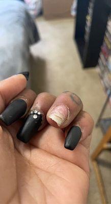 Infected finger nail