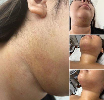 lipo double chin bichectomy post care massages