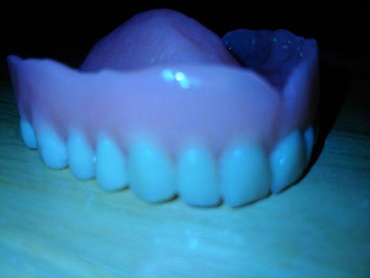 Poorly made upper denture