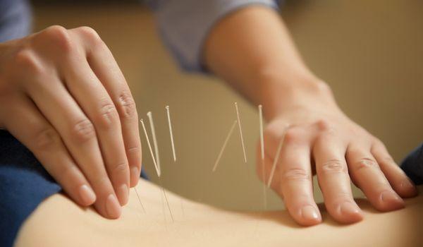 Acupuncture for Pain Relief