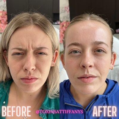 Natural Botox results