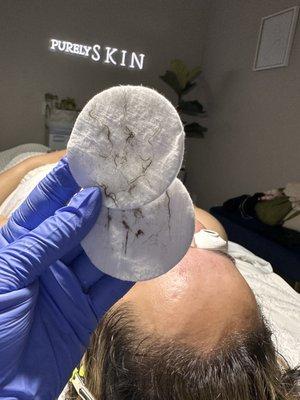 Dermaplane - removal of hair and dead skin cells