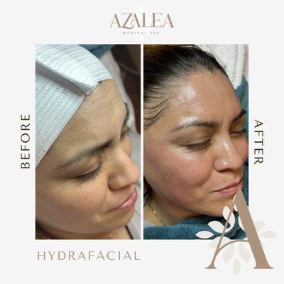 Glowing skin #Transformation!  Check out this amazing #HydraFacial #BeforeAndAfter from our own Raquel Bausby