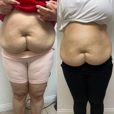 This is a fat reduction treatment combining wood therapy with cavitation