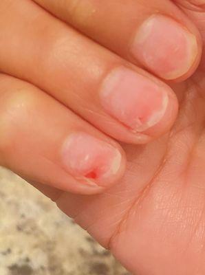 Part of pinky nail ripped off