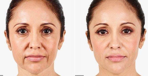 Dermal fillers and other cosmetic injectables can help your facial features appear healthier and more youthful.