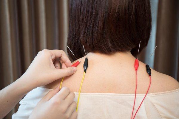 Trigger Point Dry Needling with Microcurrent Point Stimulation