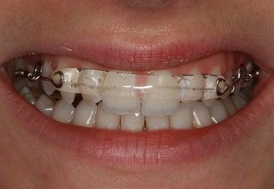 Inman Aligners