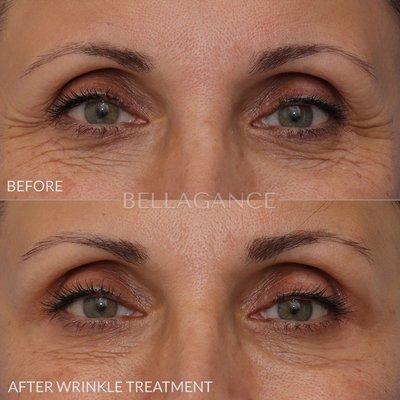 Botox treatment of the crow's feet to help soften the wrinkles at the sides of the eyes.