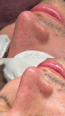 Microdermabrasion facial + extractions