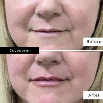 Before and after Juvéderm in lips.