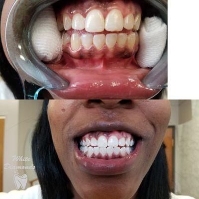 1 hour teeth whitening