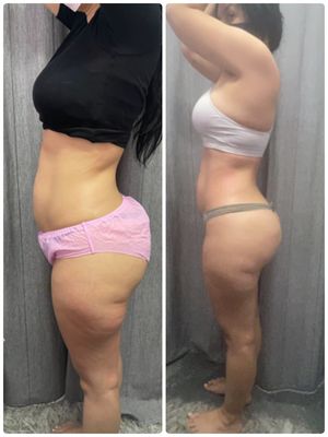 Liposuccion sin cirugía