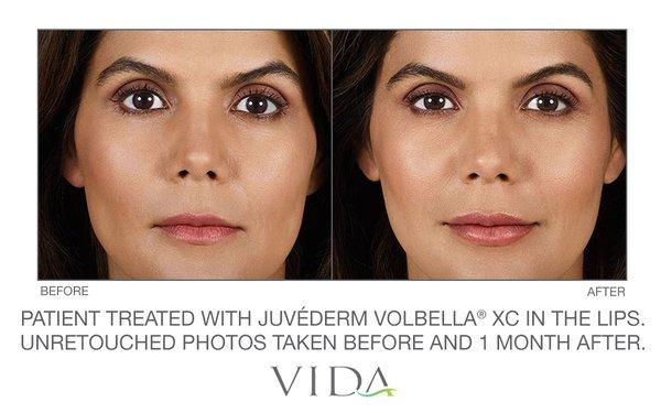 Before and after imagery depicting the subtle, but beautiful, lip plump Juvederm Volbella provides. Volbella is long-lasting, up to 18 mos!