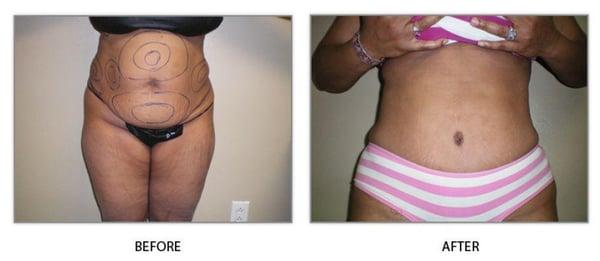 Tummy Tuck Before & After