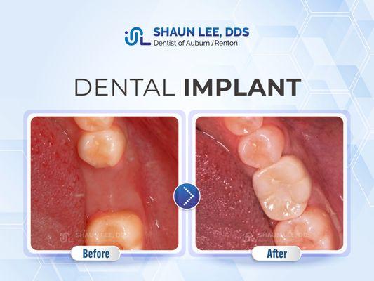 Shaun Lee, DDS Family Emergency Dental Implants of Auburn | 1320 8th St NE Ste. 103, Auburn, WA 98002 |(253)939-3440