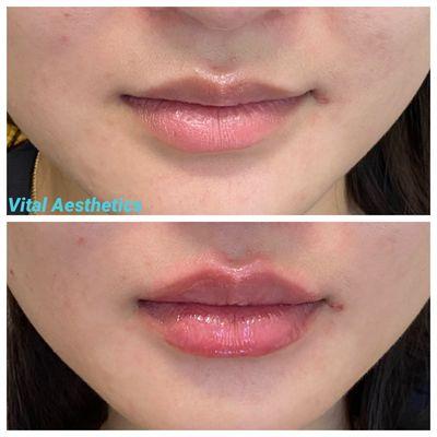 Lip filler