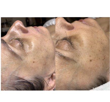 Chemical peel- instant results