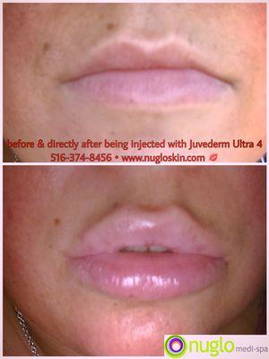 Lip fillers done by Board Certified Doctor at nu glo medi-spa