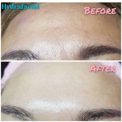 Hydrafacial