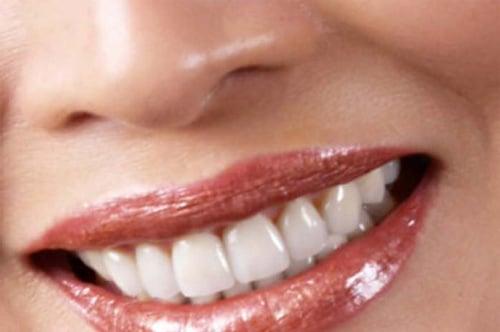 Teeth Whitening Services