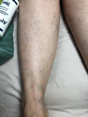 Spider vein removal (8 weeks after)