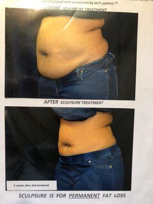 Before and After photo of SculpSure Treatment (actual client of Eze Health Center)