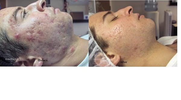 Successful Acne Cllient 3 mos. in, cleared more after 3 mos.