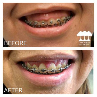 Gummy Smile Before & After