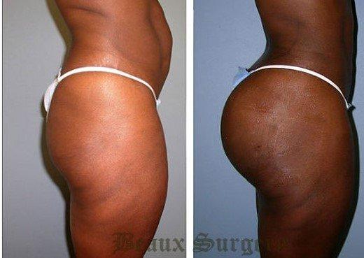 Fat Transfer 
 Secondary to liposuction / liposculpting systems: the ability to remove the fat from undesirable places with the cells intact