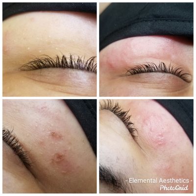 Stubborn undereye Milia extraction before and after