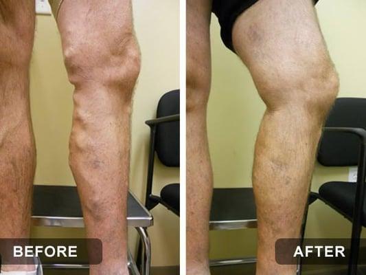 BEFORE & AFTER LASER ABLATION & REMOVAL OF VARICOSE VEINS