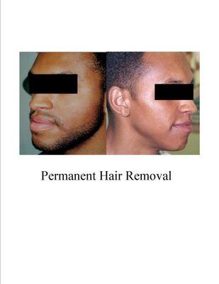 Before and after hair removal treatment